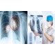 Cách Điều Trị Ung Thư Phổi Giai Đoạn Đầu Hiệu Quả Không Thể Bỏ Qua